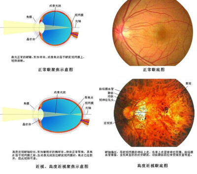 近视的眼睛