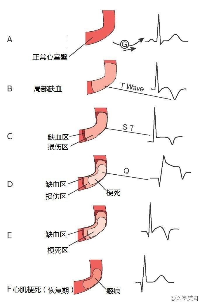 从心肌缺血到心肌梗死的心电图变化