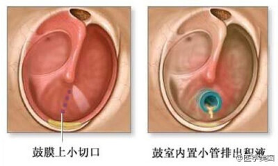 鼓室置管术