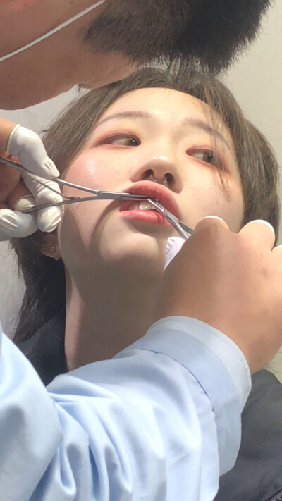 耳钉 微笑钉 耳蜗钉 耳桥