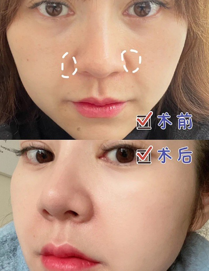 分享一例填充法令纹案例
鼻基底有点凹，法令纹有就更看着憔悴，因为时间原因，选择快速填充法令纹的方式，花了8k。
填充鼻基底的材料有玻尿酸、假体，自己适合哪种不懂得都可问哟。
