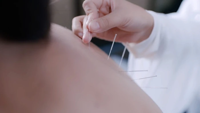针灸 - 高清图片，堆糖，美图壁纸兴趣社区