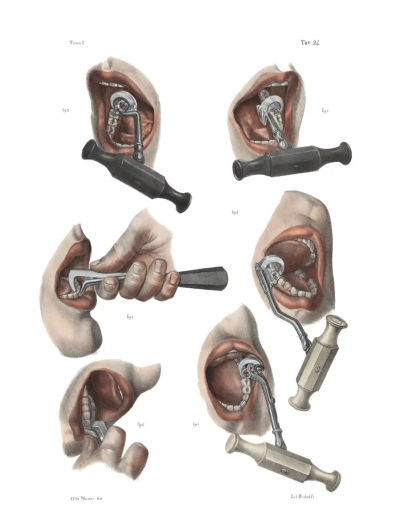 J.M.布尔热里（JM Bourgery）《人体解剖学详著》（Complete Treatise of Human Anatomy）里的各种拔牙方法，1870年左右。