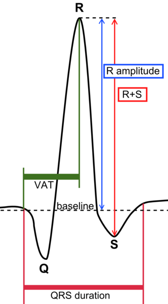 QRS complex