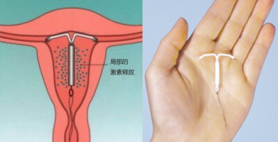 上环真的是强制的么？真怕...看看这玩意儿实际大小