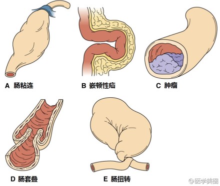 肠梗阻的常见原因