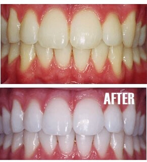 Put a tiny bit of toothpaste into a small cup, mix in one teaspoon baking soda plus one teaspoon of hydrogen peroxide, and half a teaspoon water. Thoroughly mix then brush your teeth for two minutes. Remember to do it once a week until you have reached the results you want. Once your teeth are good