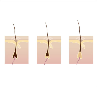 激光脱毛破坏毛囊示意图