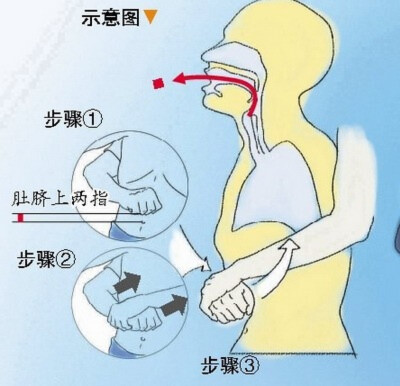 海姆立克急救法