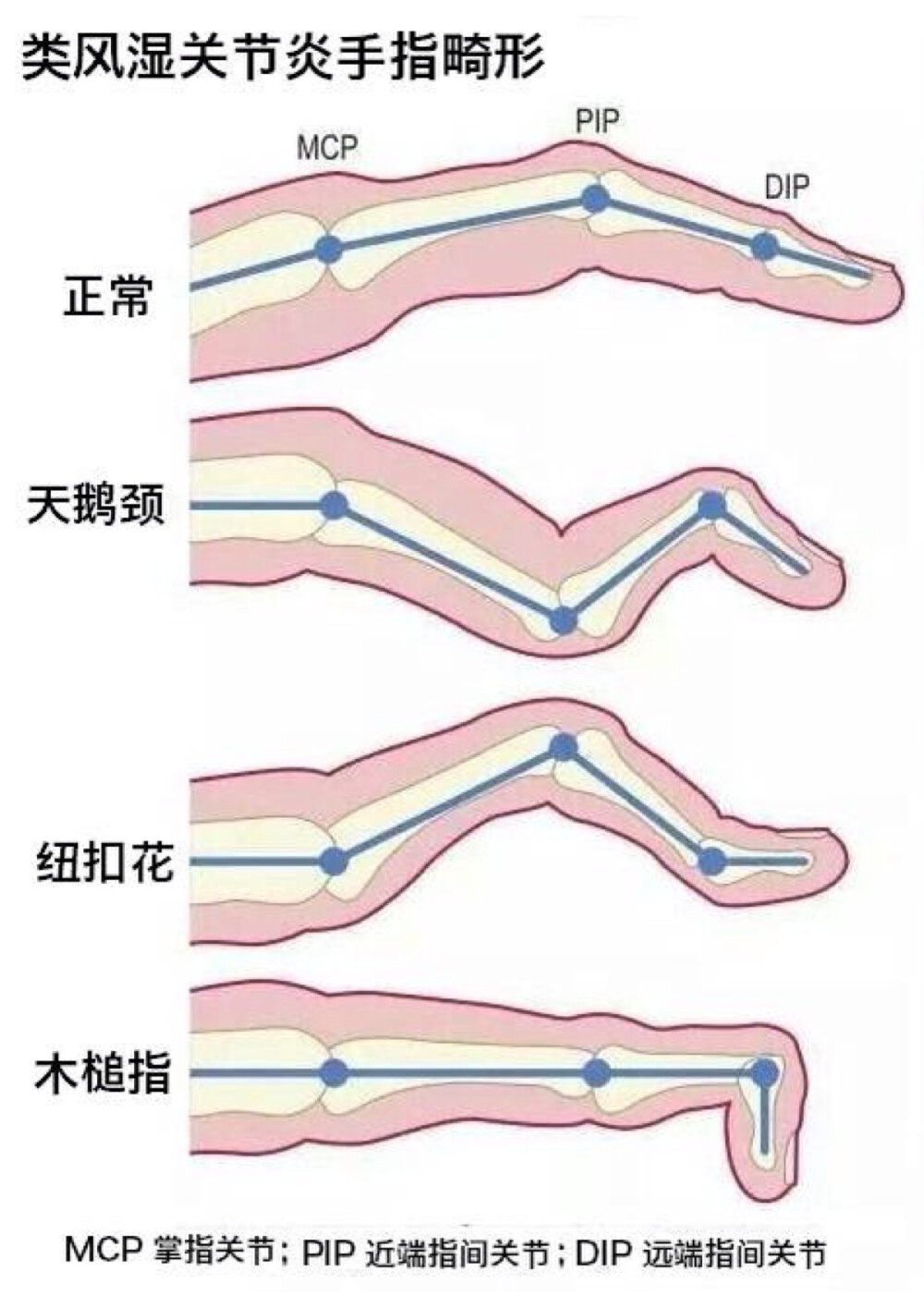 类风关手指畸形