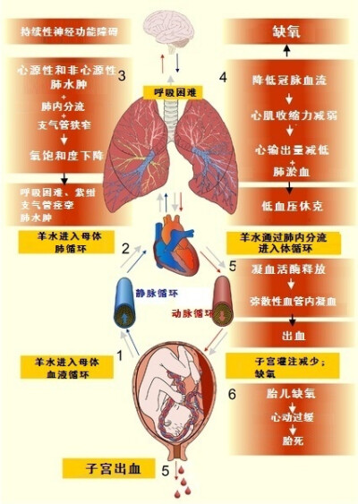 羊水栓塞