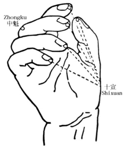 【老年中风 切莫搬动】原地头身扶正。粗针火烧消毒，刺破十指尖(十宣穴)，挤血。静侯自能清醒。口眼歪斜，刺破耳垂，鲜血出来，眼嘴复位。神清觉复，再去医院调护。如急救一路颠簸，血管脑路破裂，非死即残，仙丹奈…