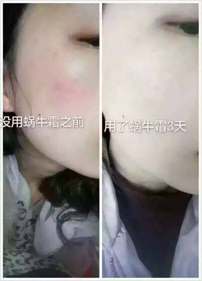 【修复】皮肤过敏，使用蜗牛霜三天后的效果大家自己看看吧