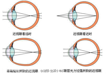 【健康养生小知识】护眼篇。——近视就这么好了？每天转眼球：先顺时针，转速极慢，左上右下，要领是只动眼不动头。向左时目光极力向左，能看多远看多远，但头不动。其它方向亦如此。转动的轨道为圆形，不只是左上右下4个点。顺时针25次逆时针25次，这时后颈会发胀（不发酸继续转），发胀才有疗效。发胀后揉两分钟。坚持做2月，你的近视就基本好了！【在网上看到的，必须要试试呐！！！最近糖糖都采不了图，只有上传，点不方便，5555~】曦 @晨曦小径