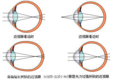 【健康养生小知识】护眼篇。——近视就这么好了？每天转眼球：先顺时针，转速极慢，左上右下，要领是只动眼不动头。向左时目光极力向左，能看多远看多远，但头不动。其它方向亦如此。转动的轨道为圆形，不只是左上右…