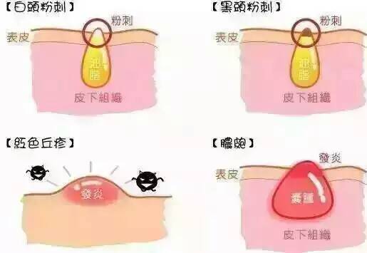  为什么春天一到痘痘不停冒？因为气温的上升、使皮脂分泌量增加、过剩的皮脂一旦与灰尘、老化的角质混合、就会堵塞毛孔、造成皮脂无法正常排出、于是、平时还老实呆在毛孔里的痤疮杆菌、得到皮脂的滋润后大量繁殖、促进了痘痘的生长、这就是为什么步入春天后、很多人都会爆痘的原因‼️