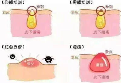  为什么春天一到痘痘不停冒？因为气温的上升、使皮脂分泌量增加、过剩的皮脂一旦与灰尘、老化的角质混合、就会堵塞毛孔、造成皮脂无法正常排出、于是、平时还老实呆在毛孔里的痤疮杆菌、得到皮脂的滋润后大量繁殖…