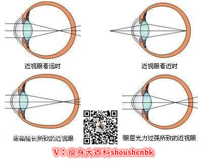 视力不好的根本原因，快点进来看看吧