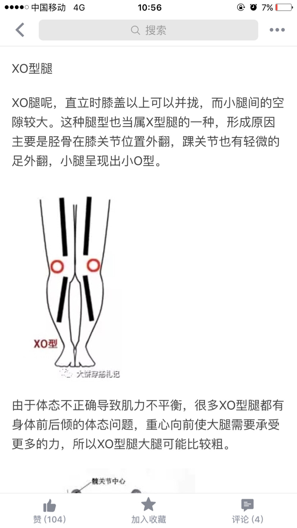 xo型腿