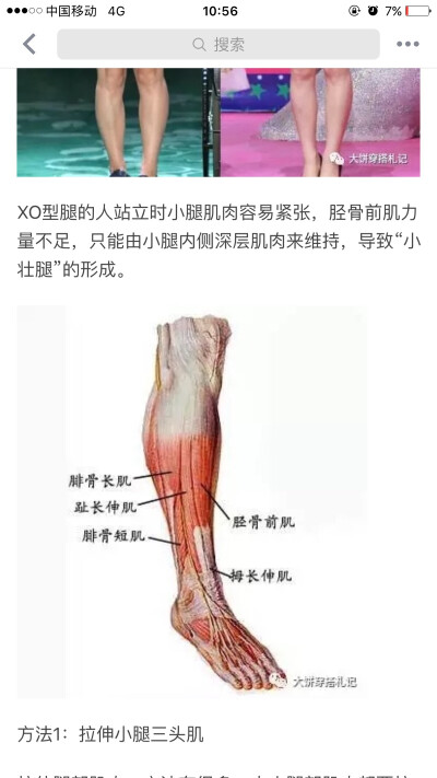 xo型腿