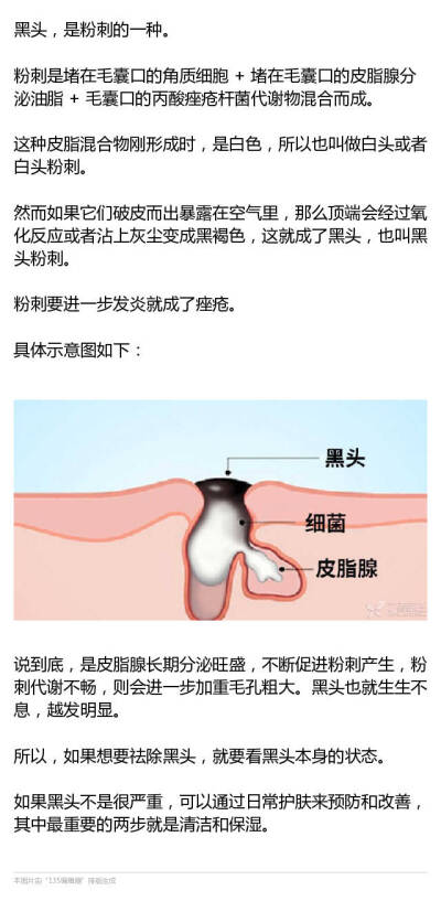 如何去除鼻子上的黑头？ ​