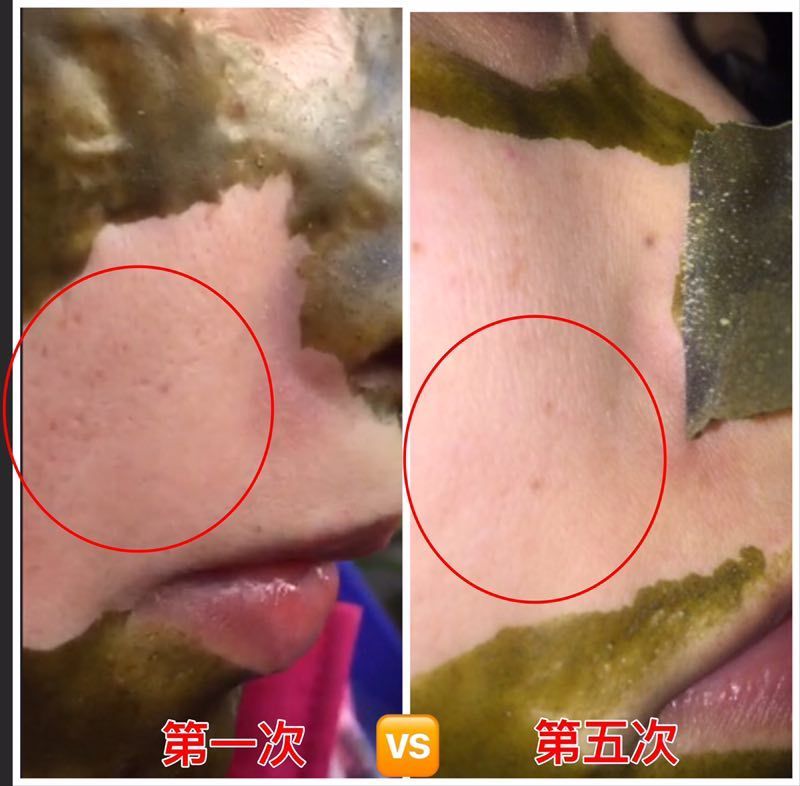 撕膜反馈
痘痘这个东西，你拖一天就严重一天，用手抠抠，用粉刺针扎扎，用点
去痘痘的药膏药水涂涂都不会干净，还会反复，那样只会耽误你治痘痘
的最佳时间。你必须要疏通毛孔，清洁干净毛孔才能达到根部治疗