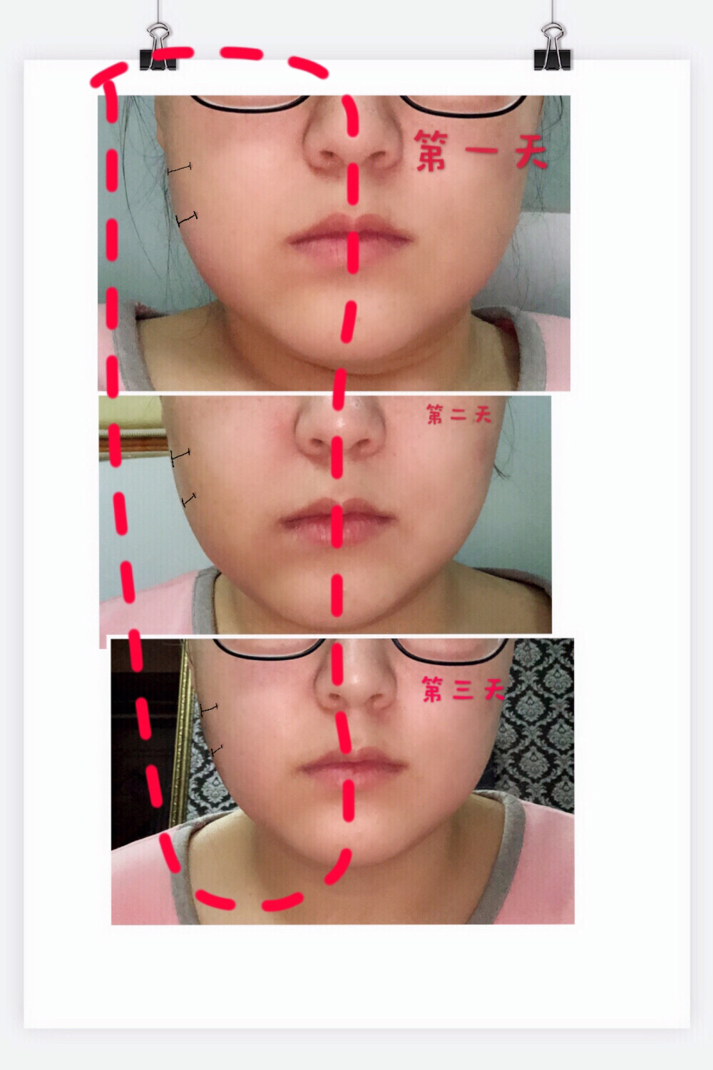 终于解决了.终于要变匀称脸了.好开心