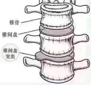 【肾虚为何会腰痛？】
跟大家科普一下：腰痛是肝不藏血，血不养筋。根本原因是肾虚了。
肾主骨生髓，所以肾虚营养不能很好的供给骨髓，骨髓造血就少了。造出来的血少了肝藏血自然而然也就少了，腰上两大筋得不到充足的血就松了，松了的筋抑制不住骨头，导致骨关节之间的磨损，把软骨磨损严重后，骨头也就容易突出来。
这就是腰椎间盘突出