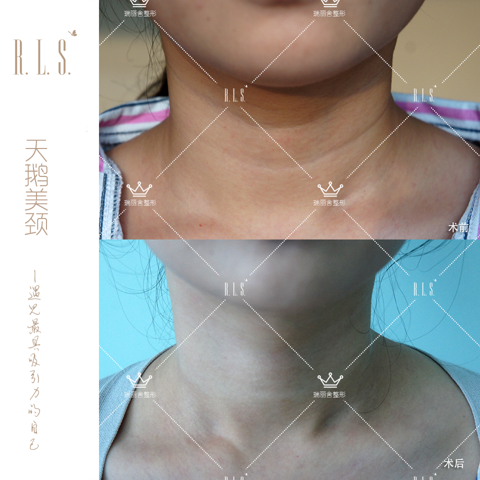 天鹅美颈，安全快速祛除颈纹，让颈项恢复如初。