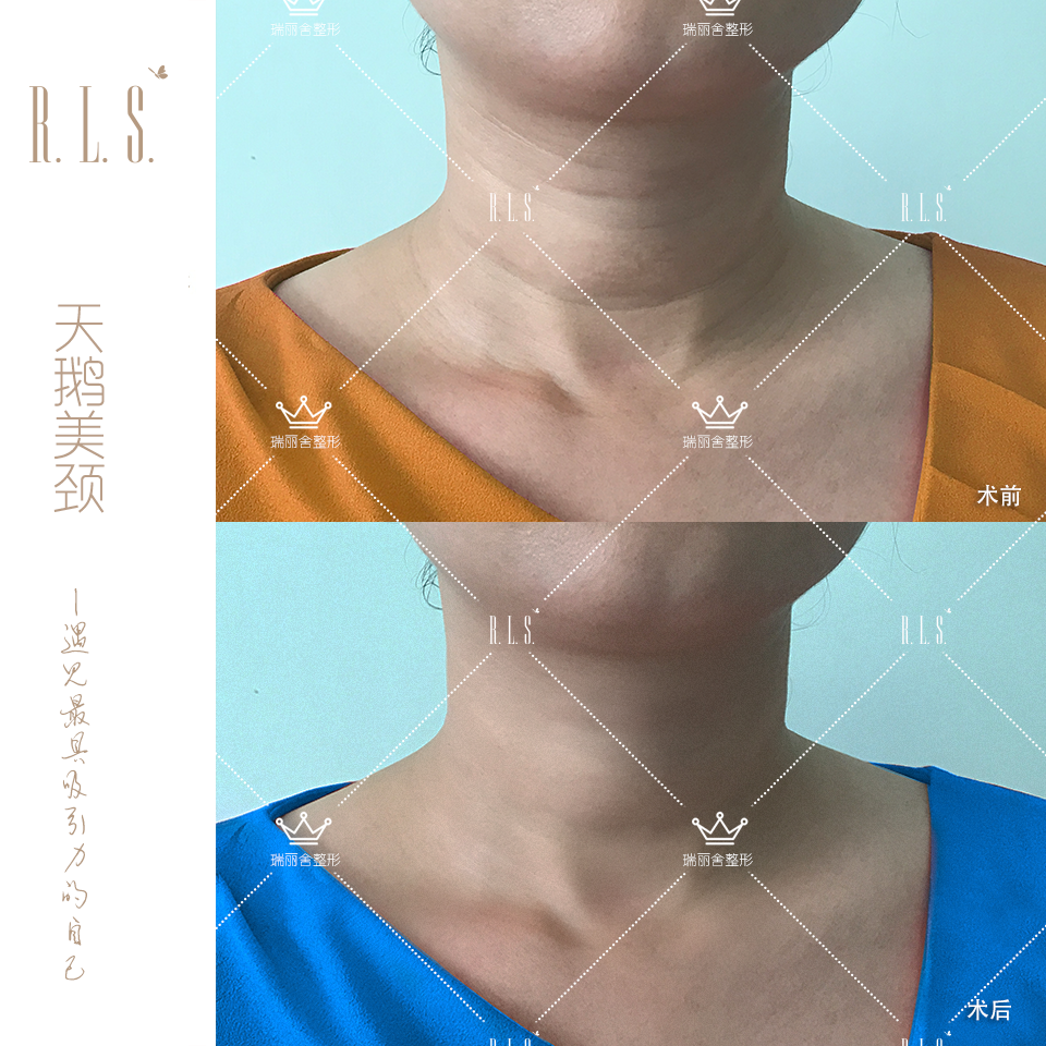 天鹅美颈，安全快速祛除颈纹，让颈项恢复如初。