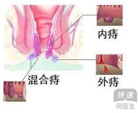 十人九痔
作为一个曾经的患者，深知痔疮的痛苦，曾痛苦过，绝望过，大概6年前绝望而且痛苦的我，带着内外加脱出的痔疮，最后选择了去动手术，那时寻药无果，戒口无用，反倒白白浪费了几千块。最后动手术花几千后…