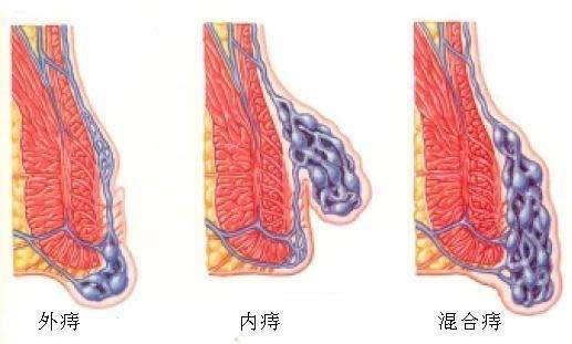 十人九痔
作为一个曾经的患者，深知痔疮的痛苦，曾痛苦过，绝望过，大概6年前绝望而且痛苦的我，带着内外加脱出的痔疮，最后选择了去动手术，那时寻药无果，戒口无用，反倒白白浪费了几千块。最后动手术花几千后也痛苦了将近2个月，头一个月因为针线问题别说大便小便都是一种痛苦，有尿痛苦撒不出，硬憋。。有大号也因疼痛不可出，出的只有血，食物只能吃粥不可吃硬的，头一个多星期走路都是问题，太疼，奉劝有想手术的别去，因为我过了几个月后又照样脱出而且大便有血，直到现在。
​ 现近期偶得朋友有家传秘方，痔疮药是其中一种，还有其他的，现已压制，老患者也能治愈，不过是多几副药的事，治好的如今比较久的有6年左右未复发，但必须严格忌口。
不管内痔还是外痔可用中草药熬制服用
如早期发现者可及时调治 避免脱出
常年痔疮患者导致湿屁股成为困惑不怕
可联系 以中草药熬制调理治根
要想根治不可手术，术后者除神医仙药外无解
严重痔疮患者导致脱出的注意事项:记得你坐过的椅子如果有湿润现象不要让他人再坐记得清洗 避免传染他人[抱拳]
所言皆是陈述事实，无半点语言，爱信不信，不喜妄语
