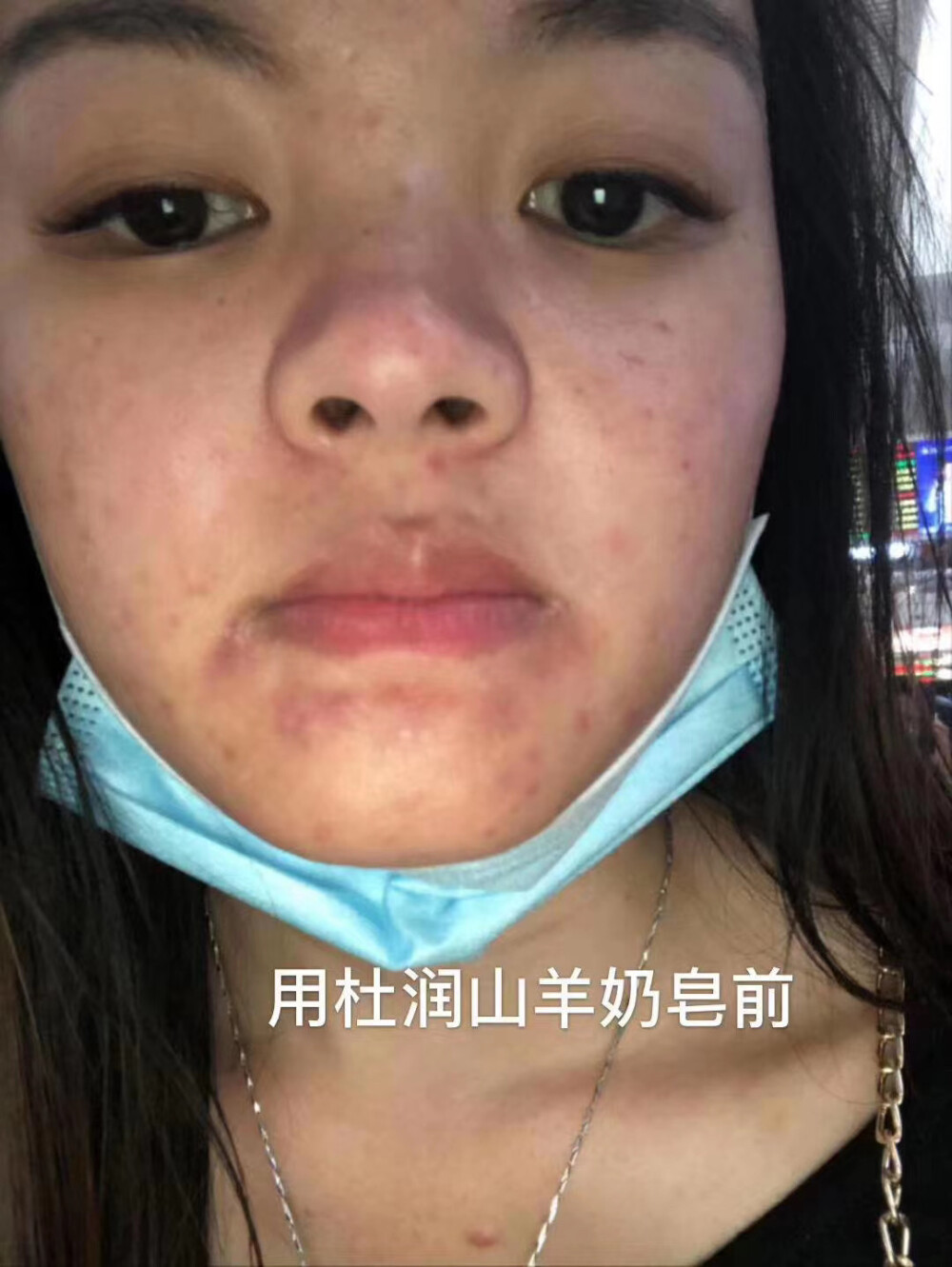 「奶皂好评
顾客用了奶皂体验装一周的效果 真的超级明显，马上来回购杜润山羊奶皂[强]
奶皂里面的成分对于辅助祛痘是真的很好，所以选择我们奶皂是选择对了[爱心] 不然我们不会推荐 自用